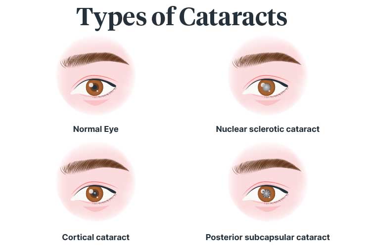 types of cataracts