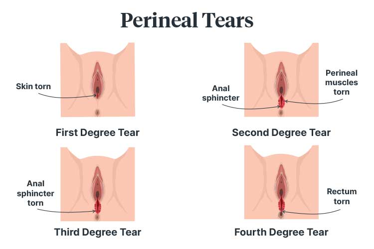 perineal tear classification