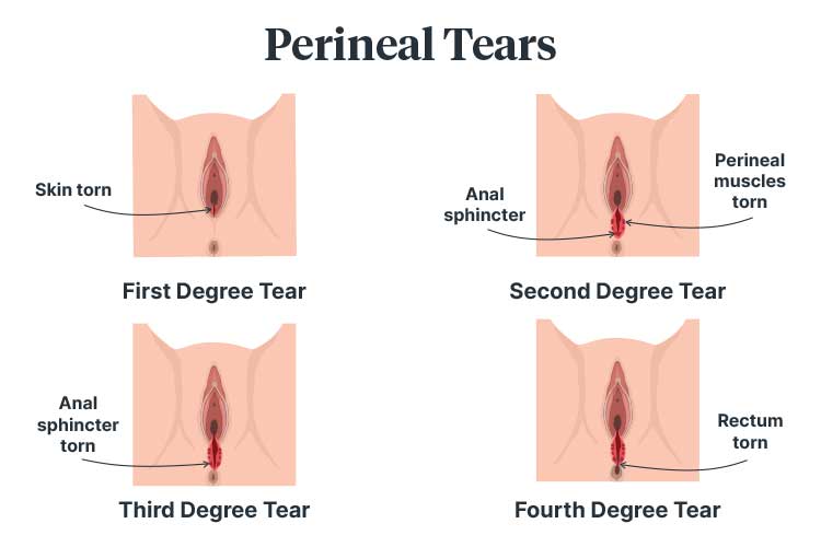 Recovering from a perineal tear