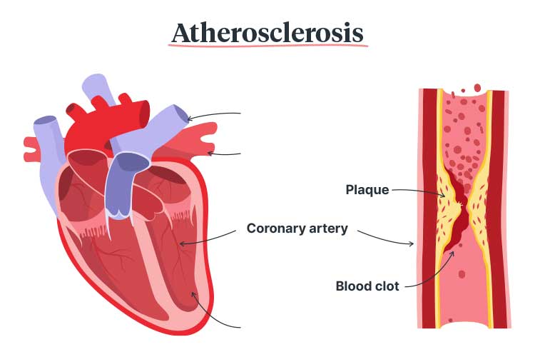acute coronary syndromes atherosclerosis diagram