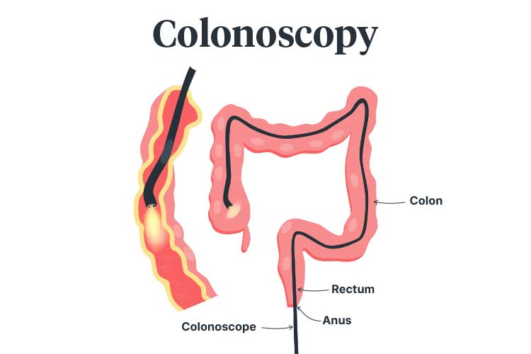colonoscopy diagram