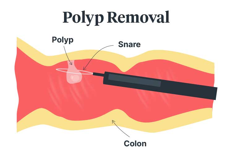 colonoscopy polyp removal