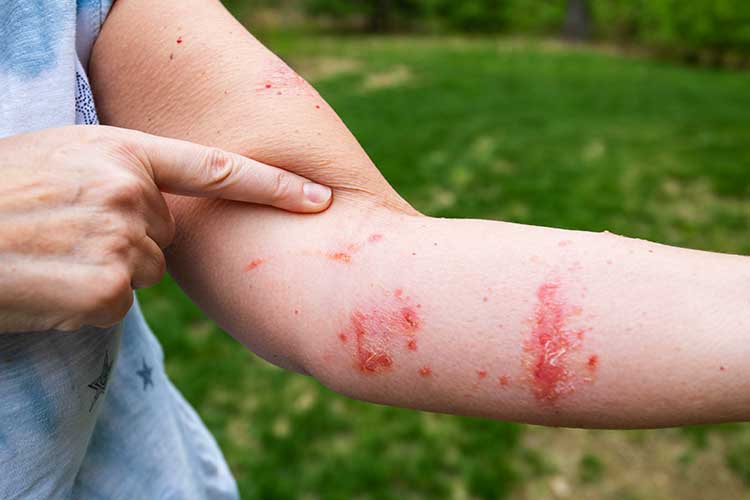 Acute Management of Poisoning poison ivy rash