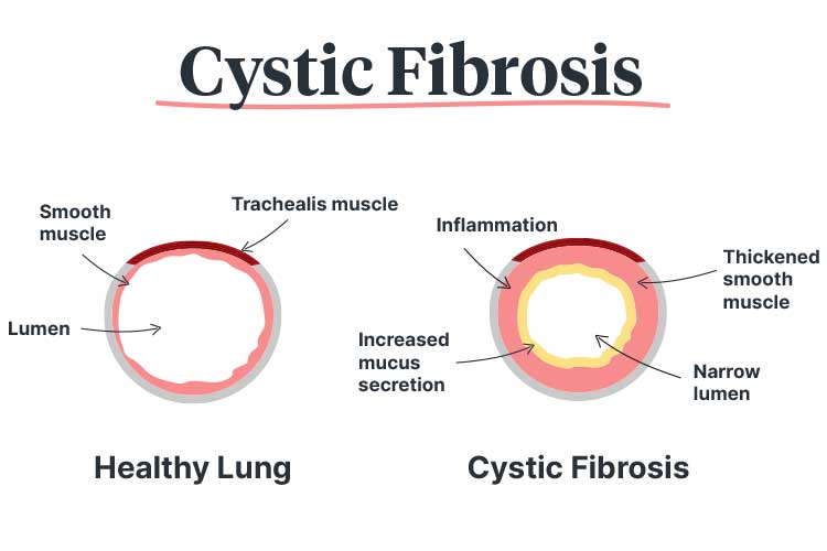 cystic fibrosis lungs