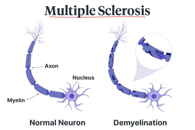 multiple sclerosis demyelination