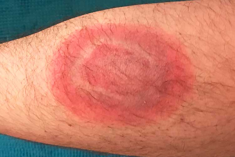 lyme disease erythema migrans