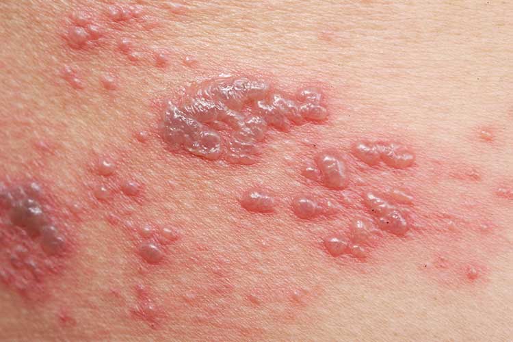 shingles herpes zoster rash