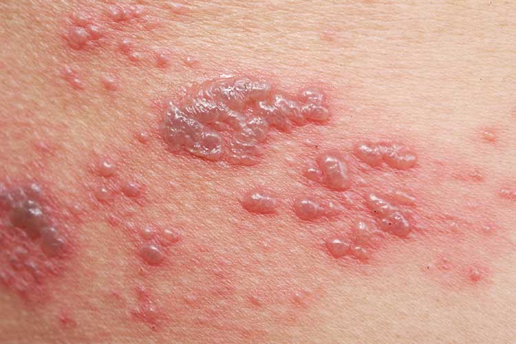 What Causes Shingles Herpes Zoster Ausmed