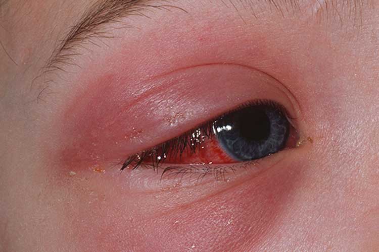 cellulitis eye