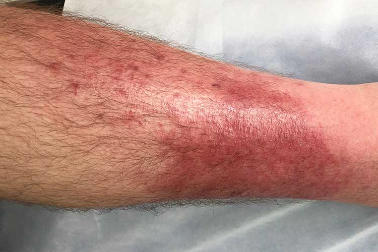 cellulitis lower leg