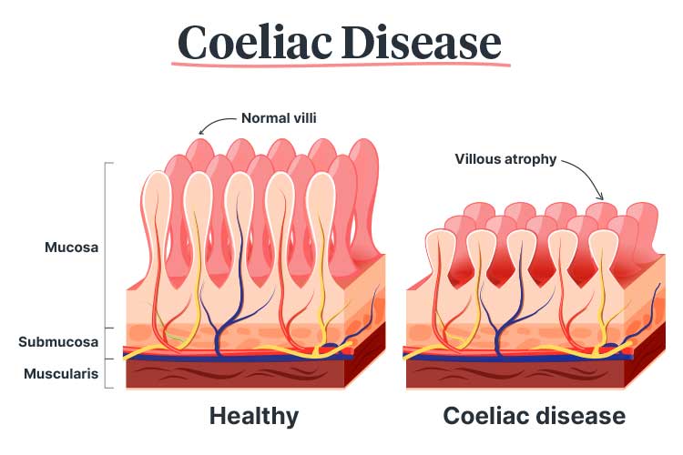 Coeliac Disease An Overview Ausmed