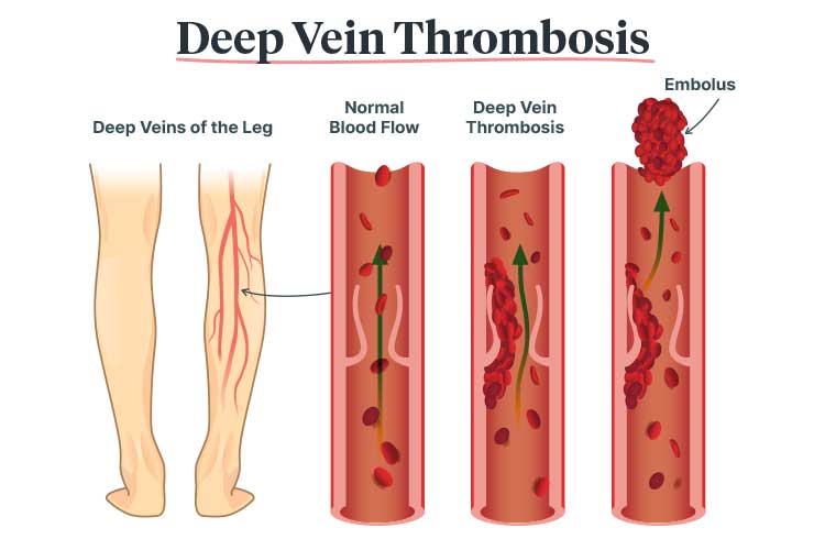 Difference Between Blood Clot and Tissue