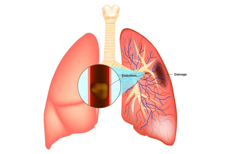 blood clot pulmonary embolism