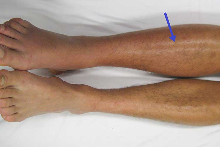 blood clot deep vein thrombosis photo