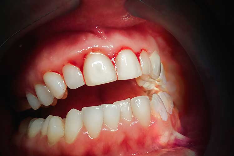 gum disease gingivitis