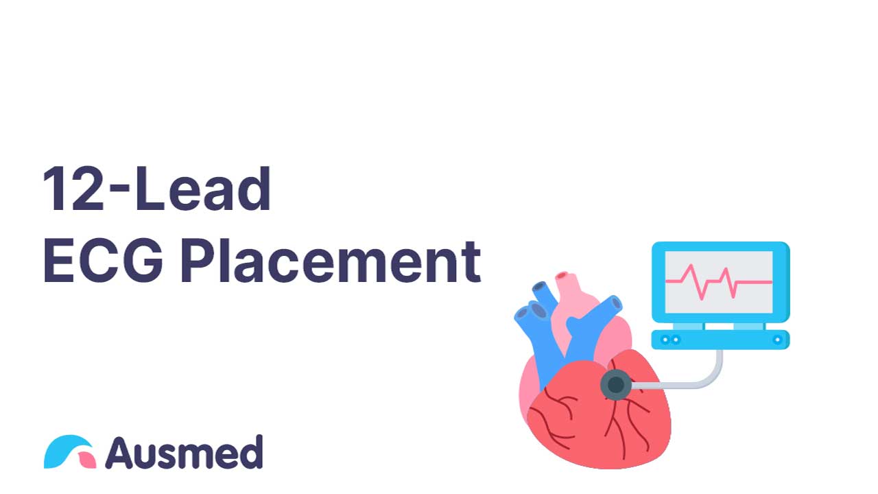 12Lead ECG Placement Ausmed Explainer